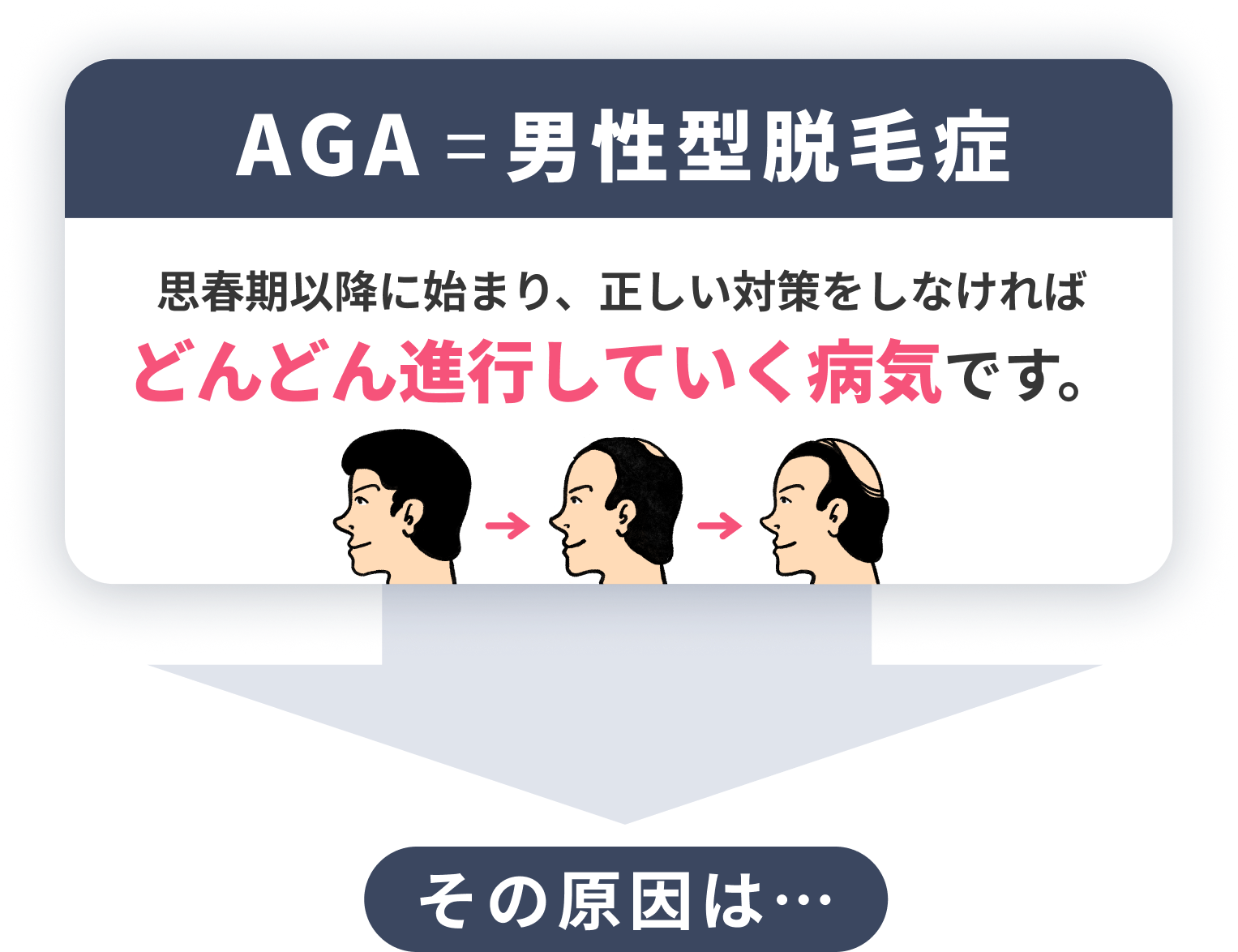 AGA＝男性型脱毛症 思春期以降に始まり、正しい対策をしなければどんどん進行していく病気です。