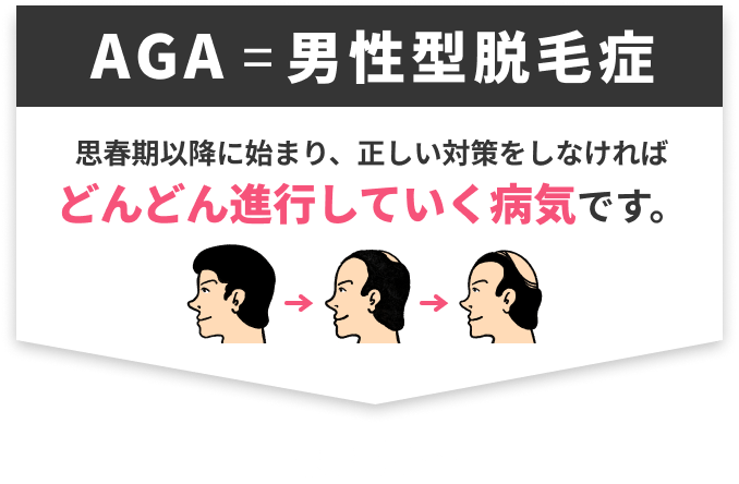 AGA＝男性型脱毛症 思春期以降に始まり、正しい対策をしなければどんどん進行していく病気です。